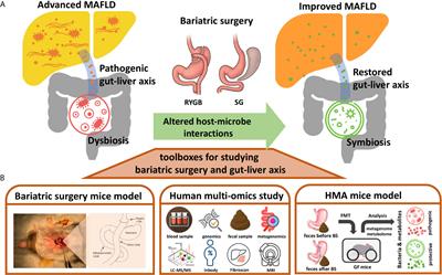 Mining Gut Microbiota From Bariatric Surgery for MAFLD